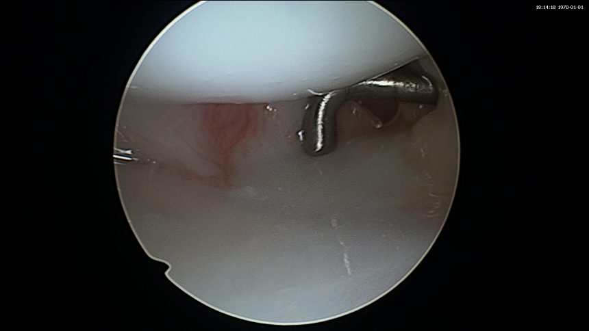 une image d'arthroscopie du poignet montrant un ligament scapholunaire sain