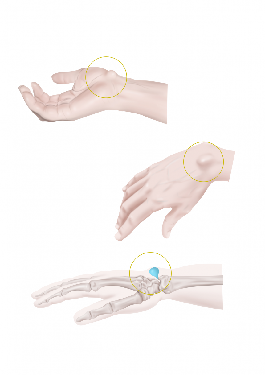 Kyste du poignet - Institut Aquitain De La Main