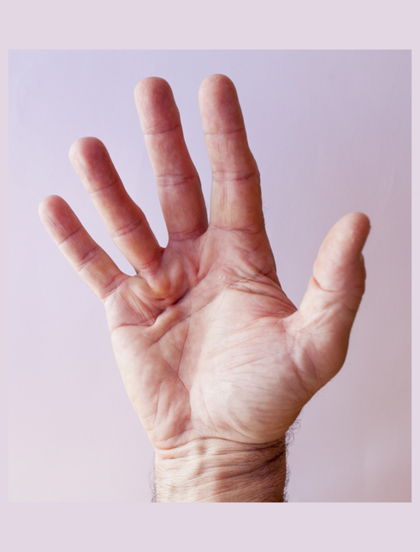 maladie de dupuytren de la main