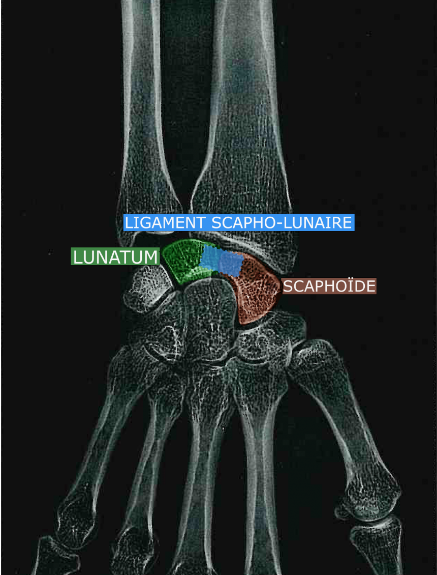 Ligament scapho-lunaire Bordeaux - Institut Aquitain De La Main