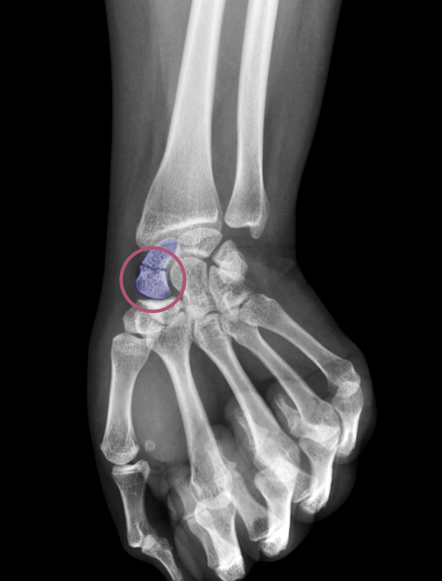 Fracture Du Scapho de Institut Aquitain Main Bordeaux