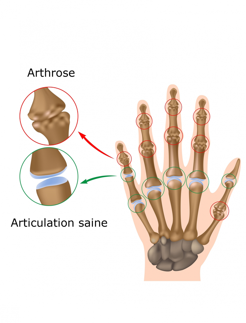 arthrose des doigts