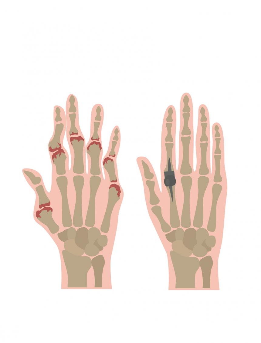 arthrose et prothese de doigt