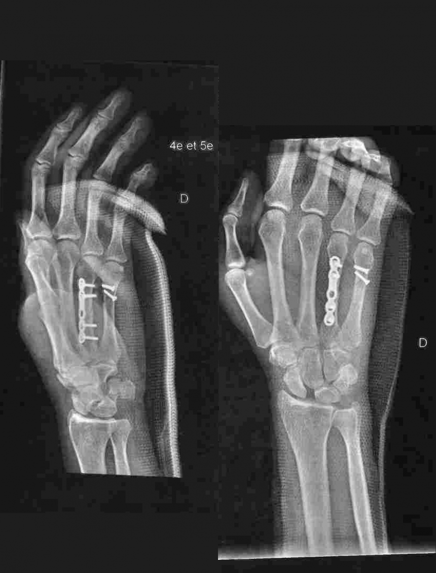 plaques et vis pour traitement de fractures de la main