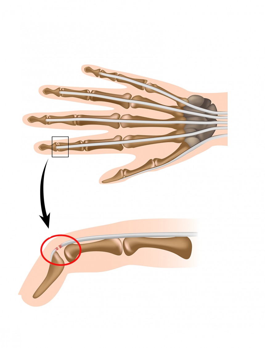 dessin du mécanisme du mallet finger