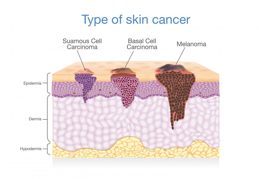 coupe histologique de tumeur de la peau